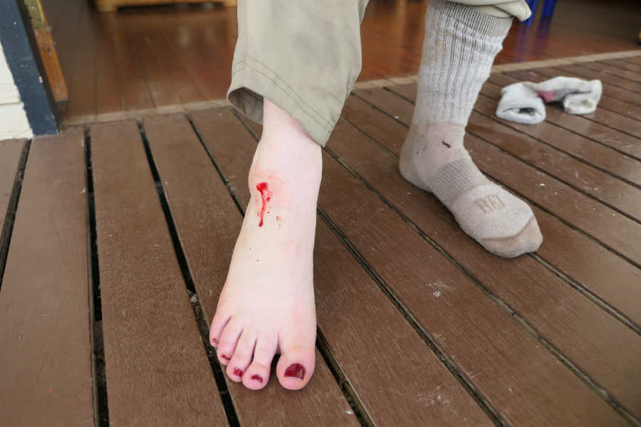 A picture of an injured leg bleeding